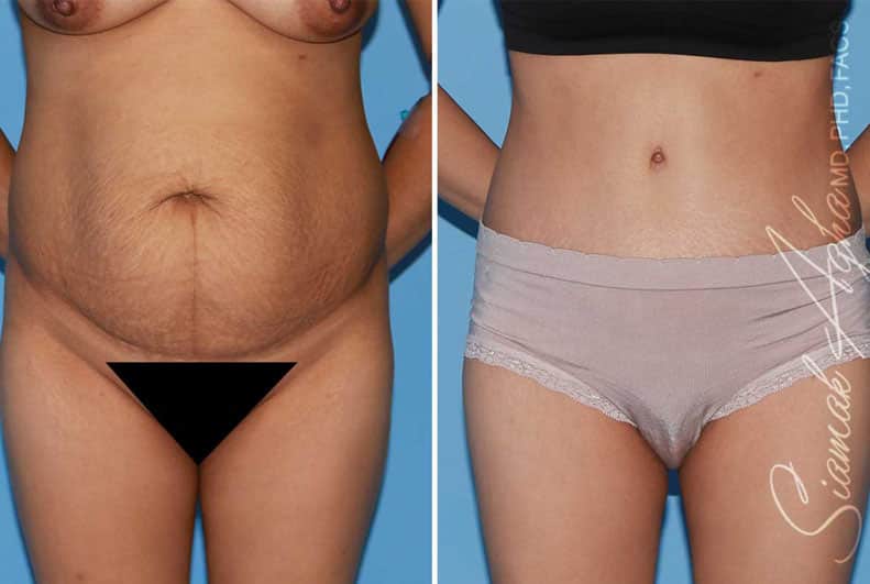 Tummy Tuck Revision