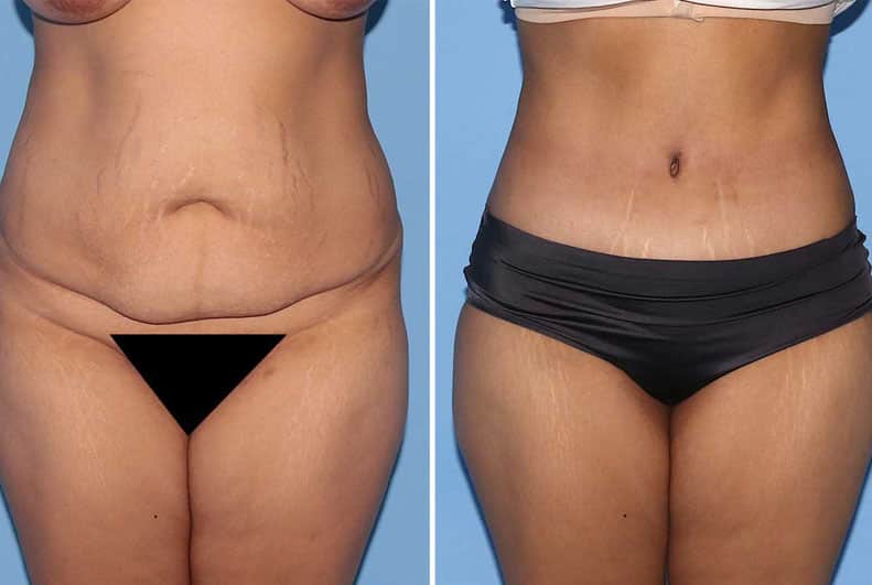 Tummy Tuck