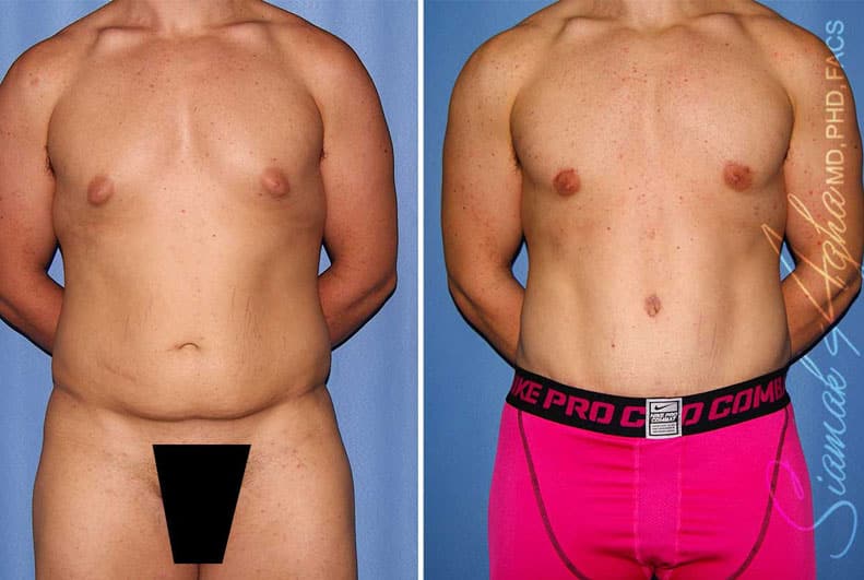 Tummy Tuck