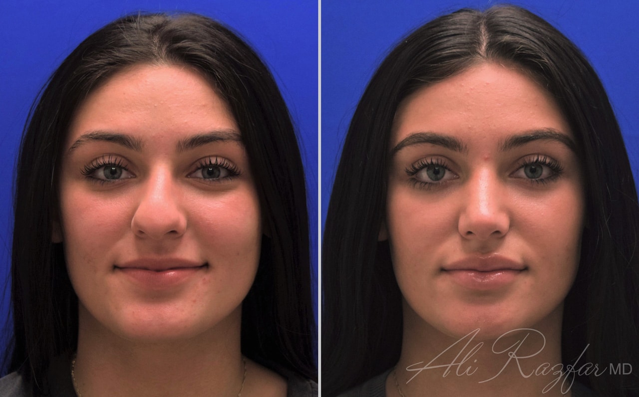 Rhinoplasty