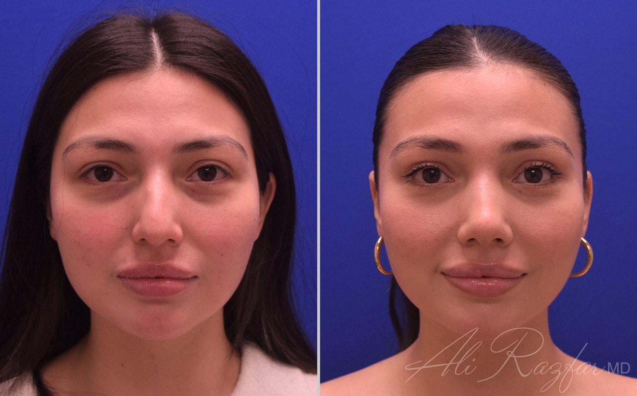 Rhinoplasty