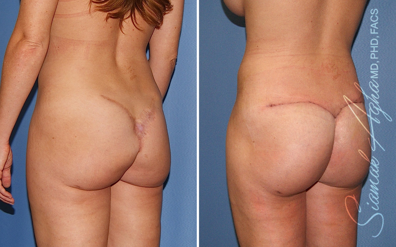 Botched Buttock Correction Patient 1