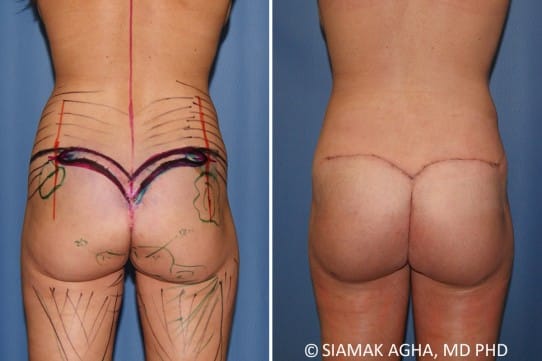 Botched Buttock Correction Patient 1