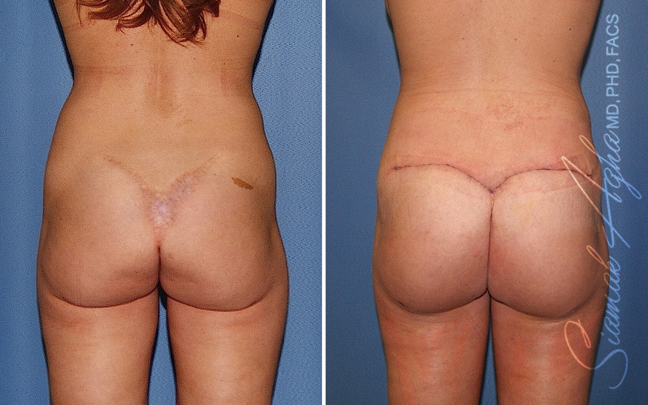 Botched Buttock Correction Patient 1