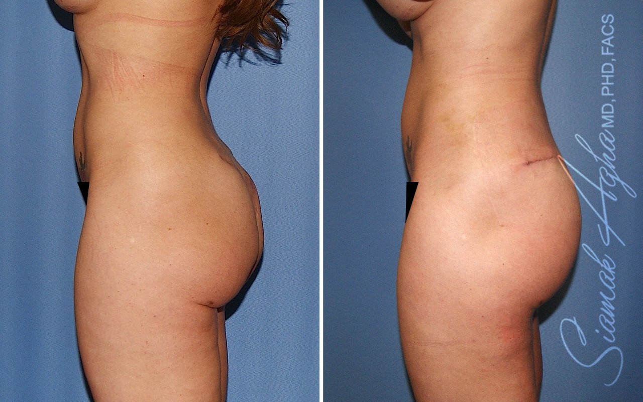 Botched Buttock Correction Patient 1