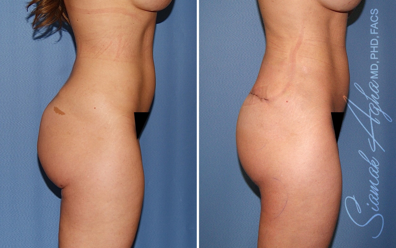 Botched Buttock Correction Patient 1