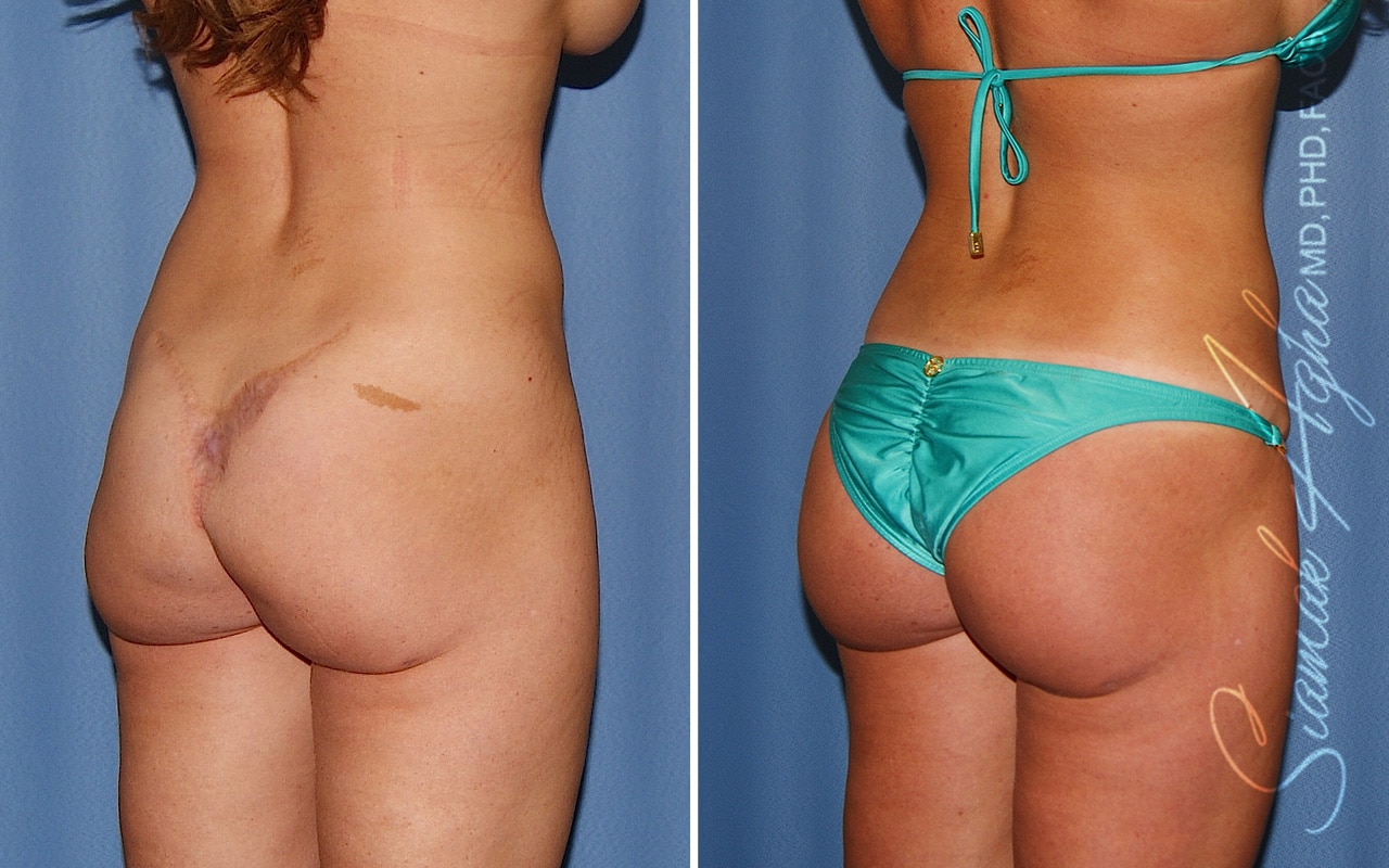 Botched Buttock Correction Patient 1