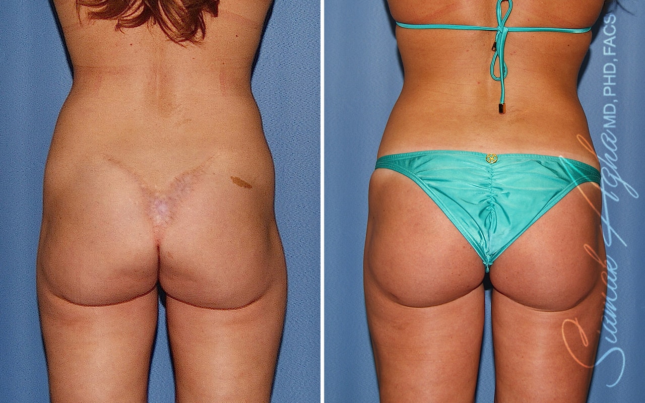 Botched Buttock Correction Patient 1