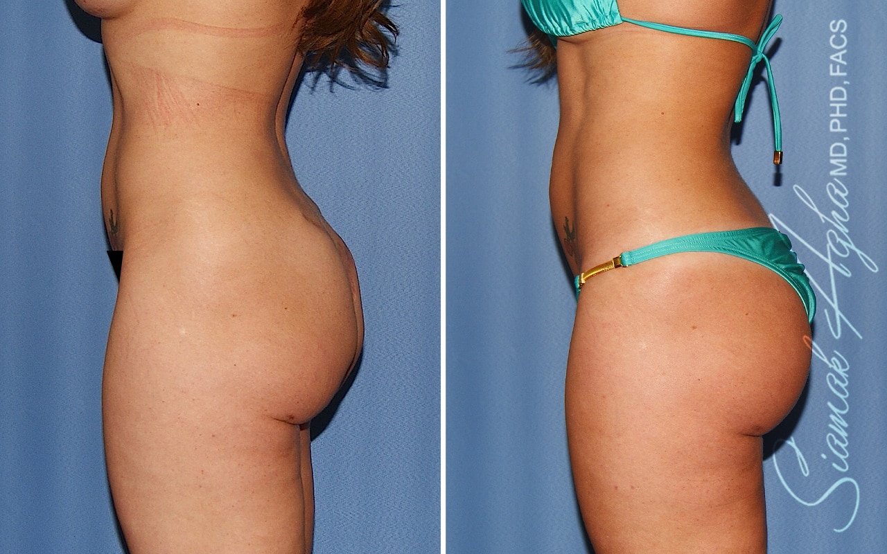 Botched Buttock Correction Patient 1