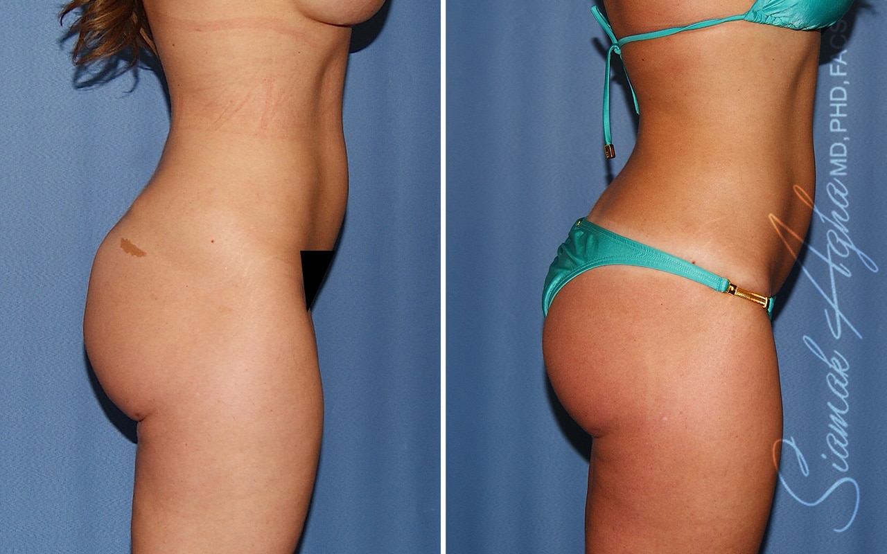 Botched Buttock Correction Patient 1