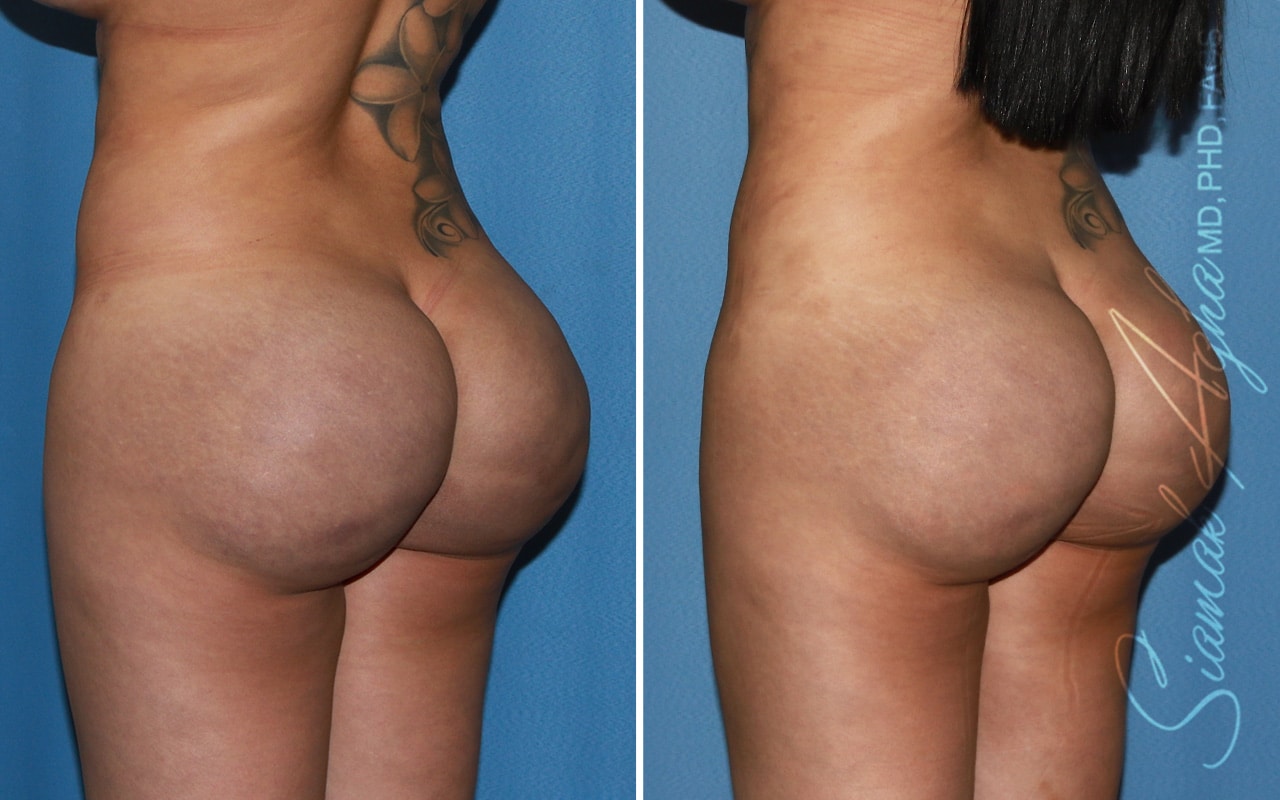 Botched Buttock Correction Patient 2