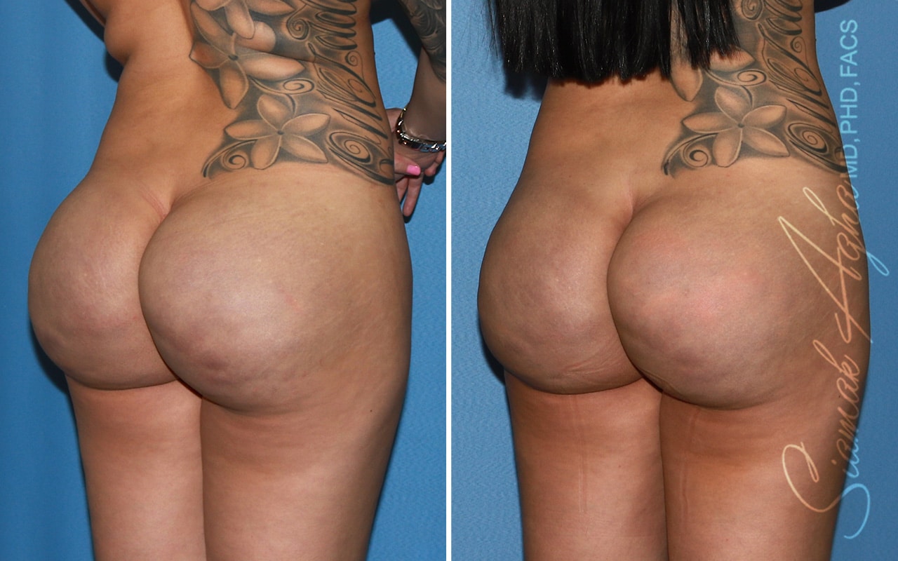 Buttock Correction Before &#038; After Photos