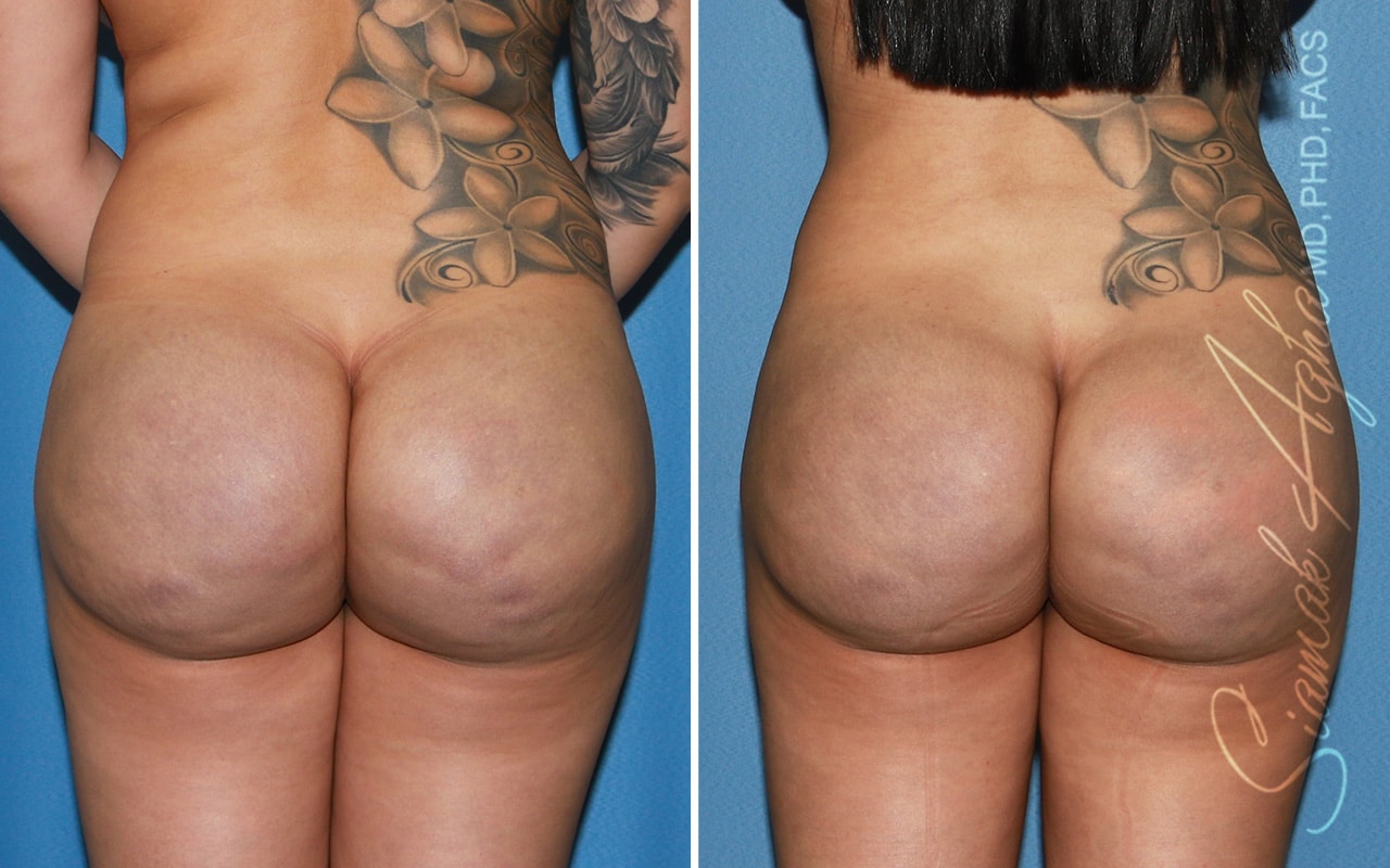 Botched Buttock Correction Patient 2