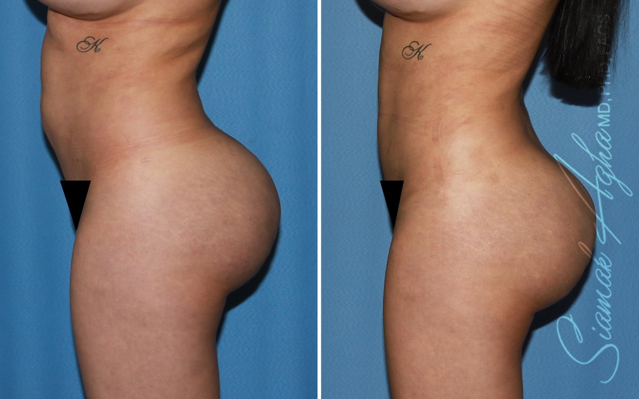 Botched Buttock Correction Patient 2