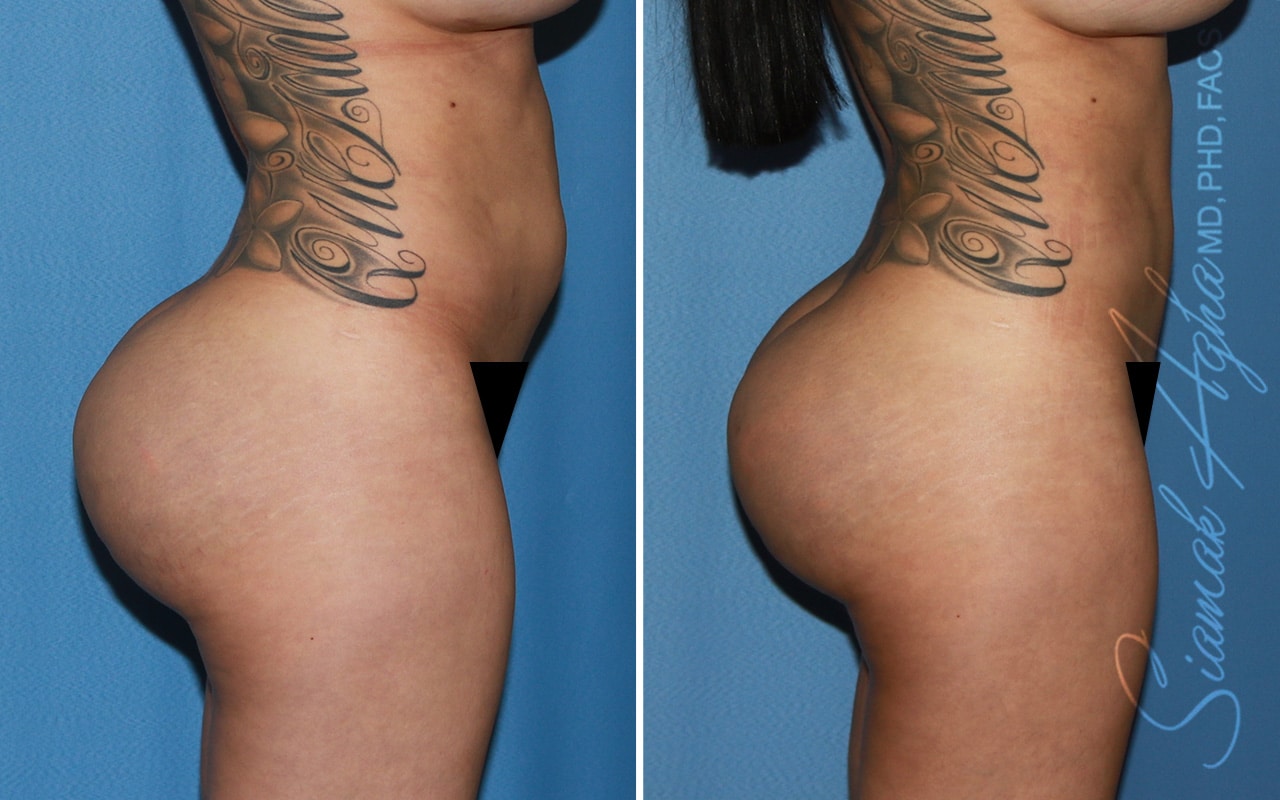 Botched Buttock Correction Patient 2