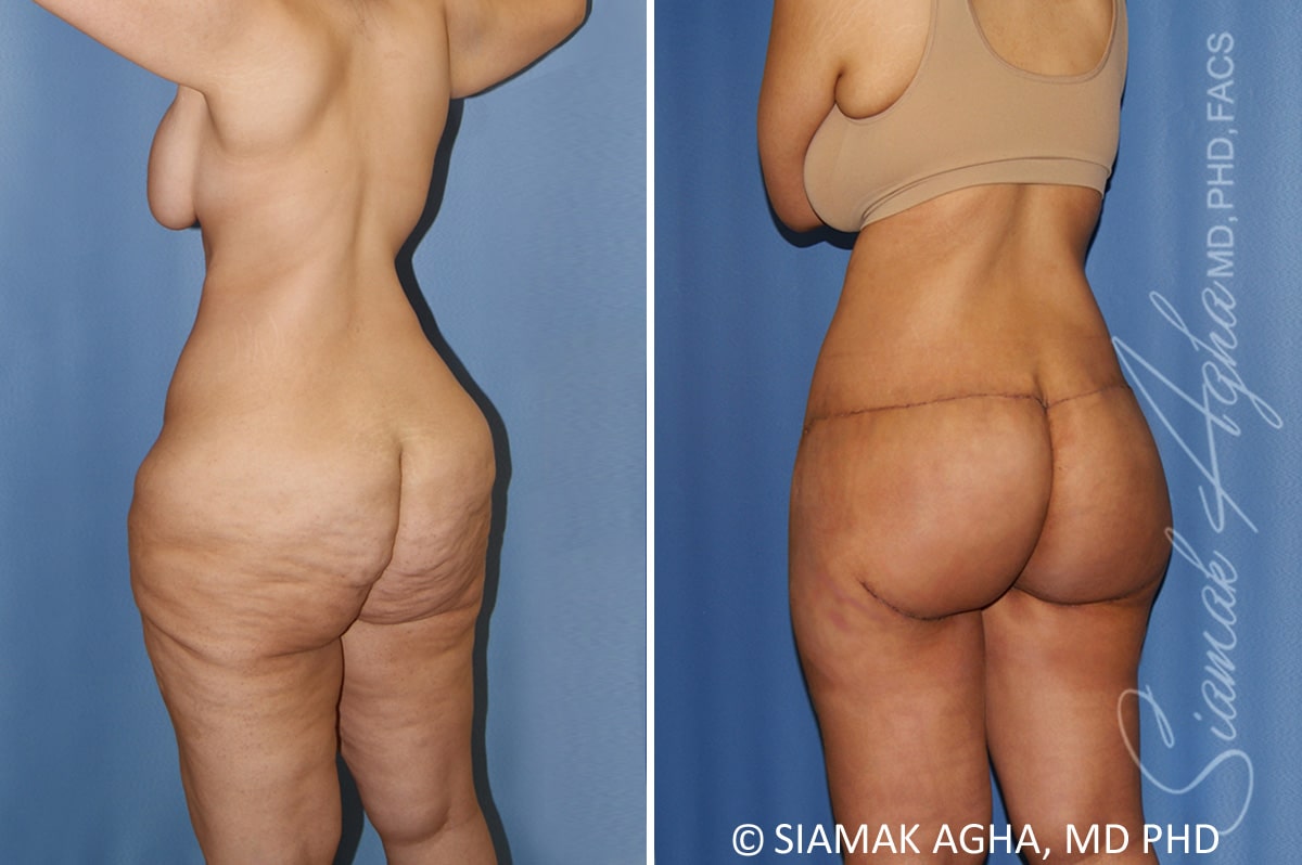 Total Body Lift Patient 34