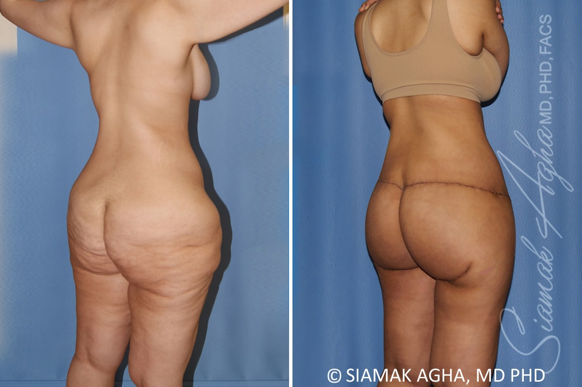 Total Body Lift Patient 34