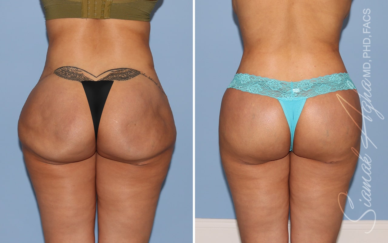 Botched Buttocks Correction Patient 3