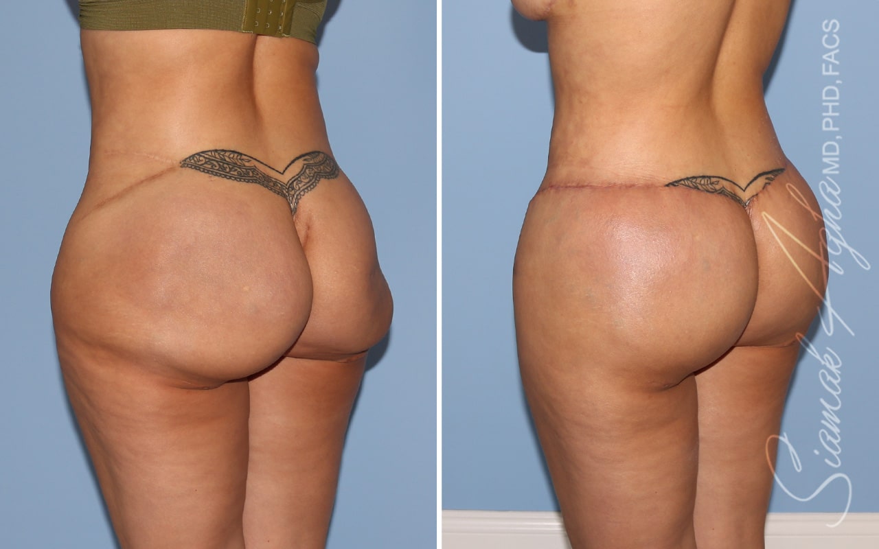 Botched Buttocks Correction Patient 3