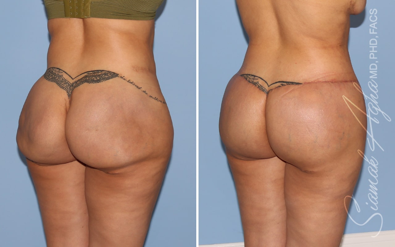 Botched Buttocks Correction Patient 3