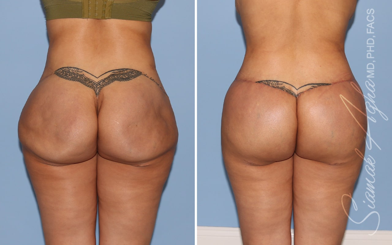 Buttock Correction Before &#038; After Photos