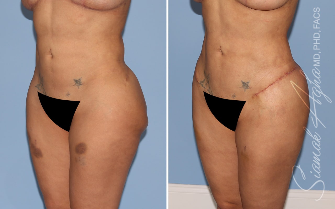 Botched Buttocks Correction Patient 3