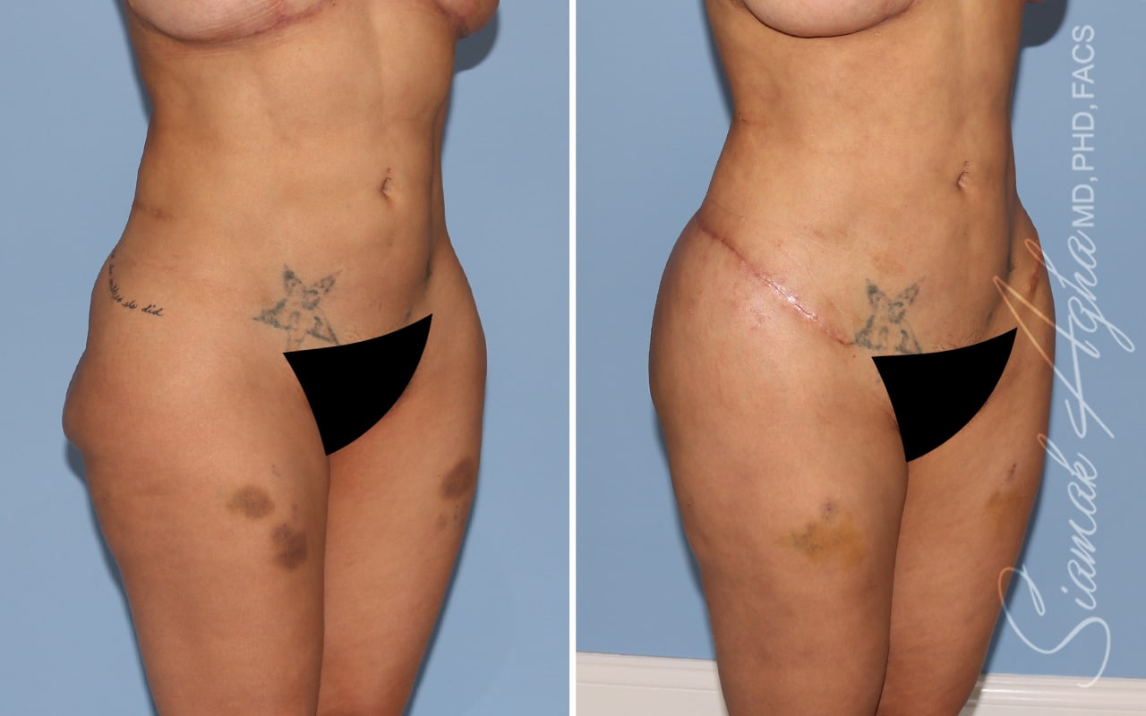 Botched Buttocks Correction Patient 3