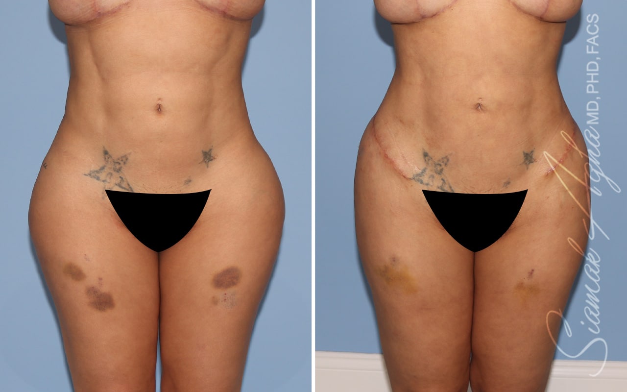 Botched Buttocks Correction Patient 3