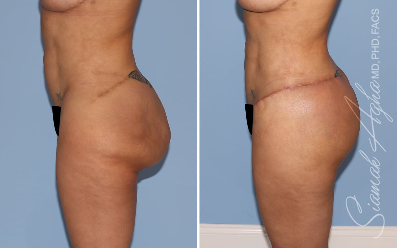 Botched Buttocks Correction Patient 3