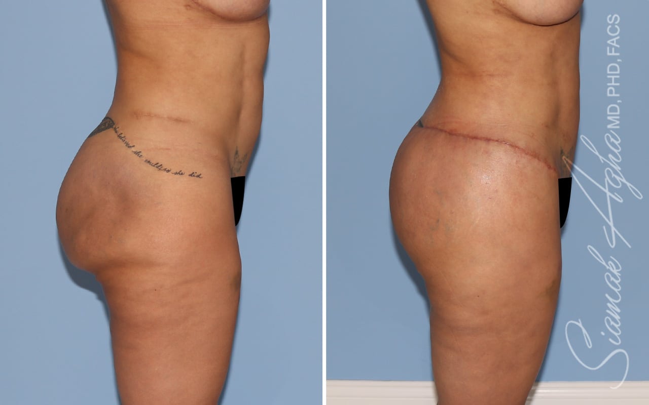 Botched Buttocks Correction Patient 3