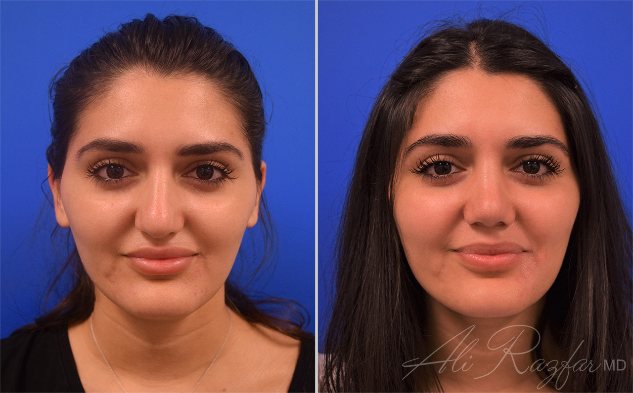 Rhinoplasty