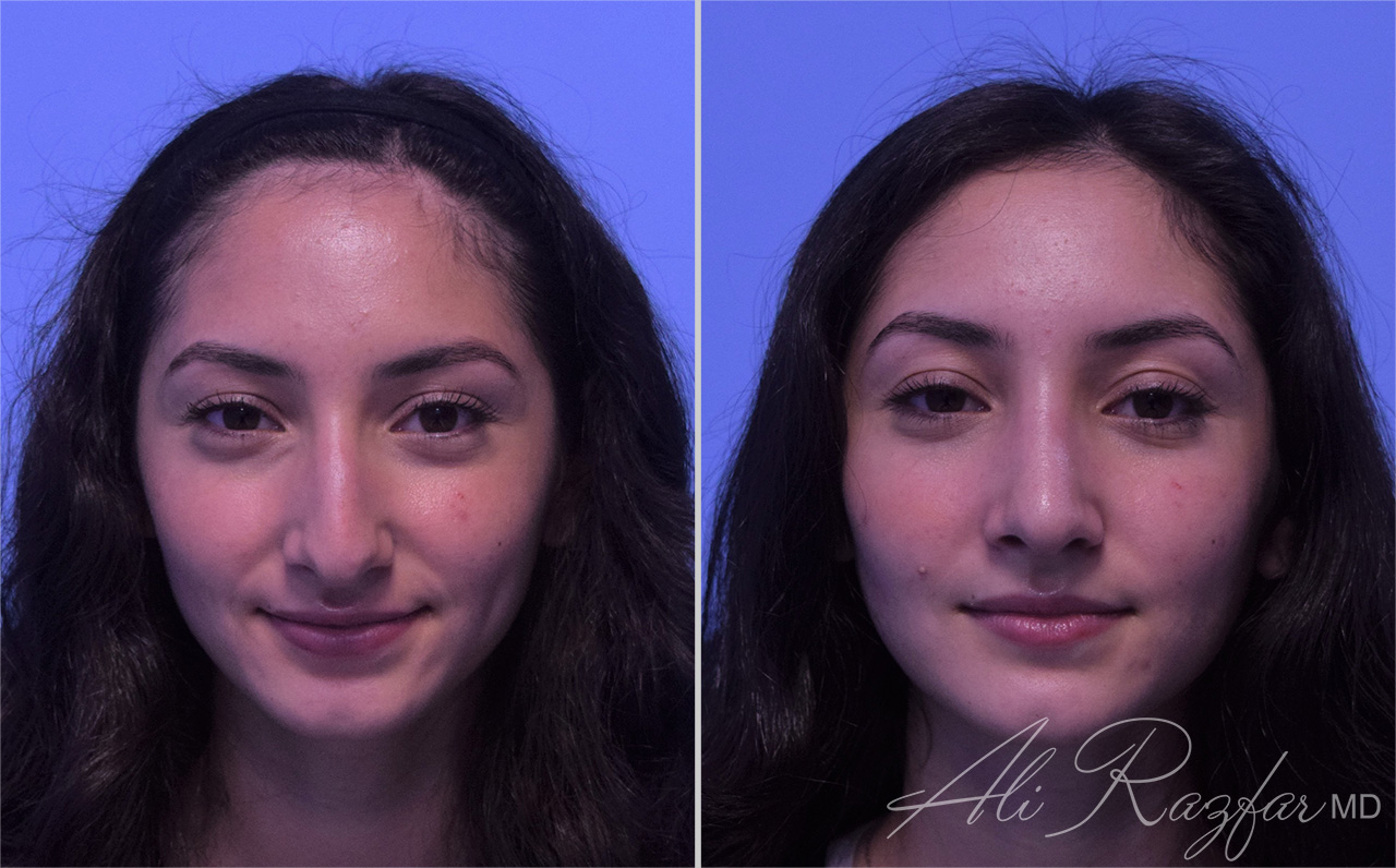 Rhinoplasty