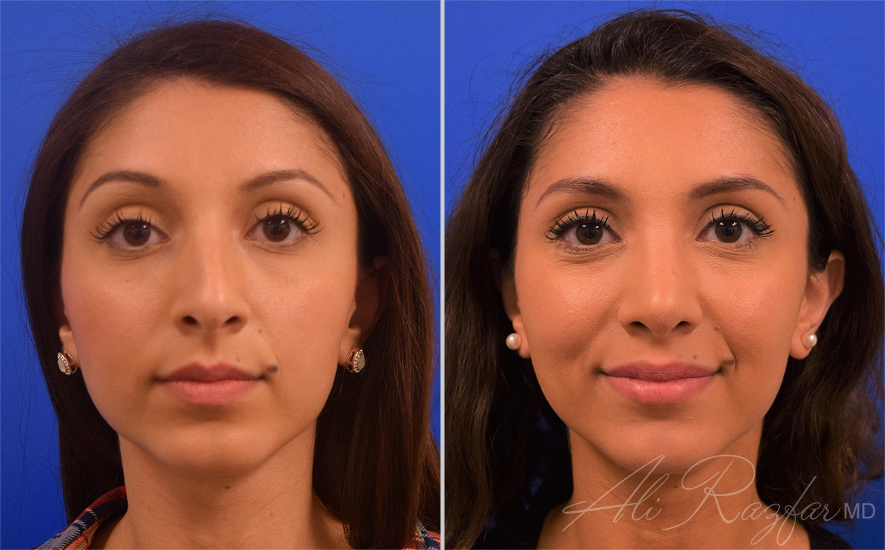 Rhinoplasty