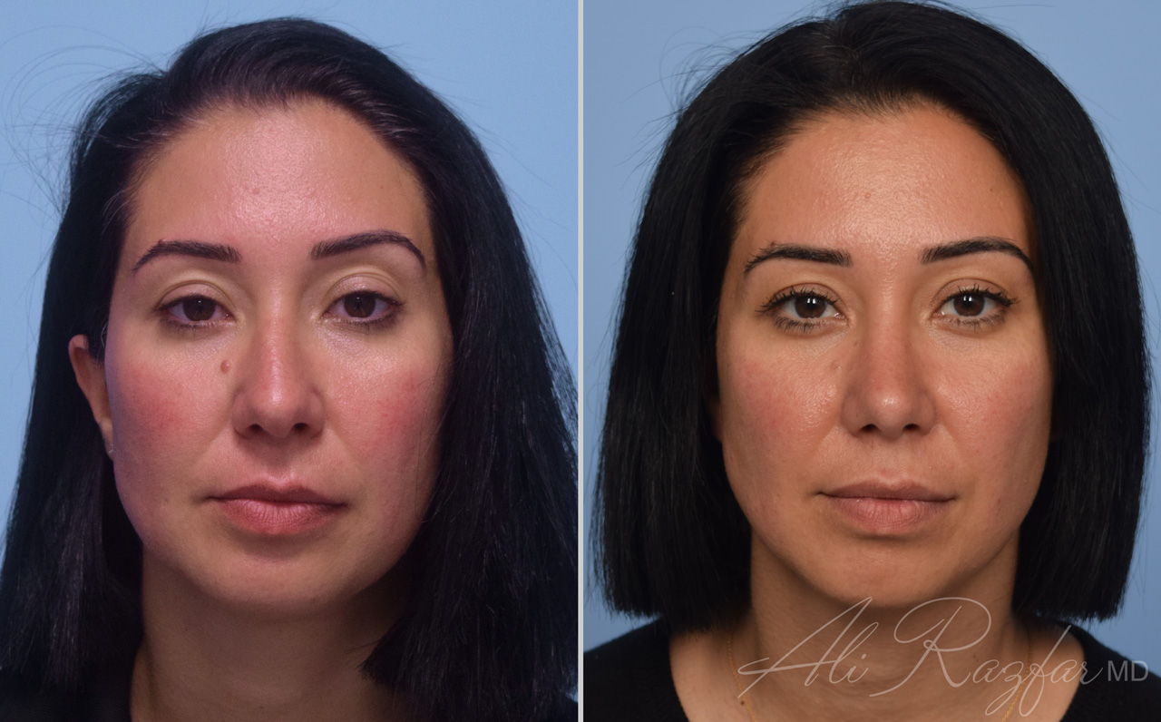 Rhinoplasty