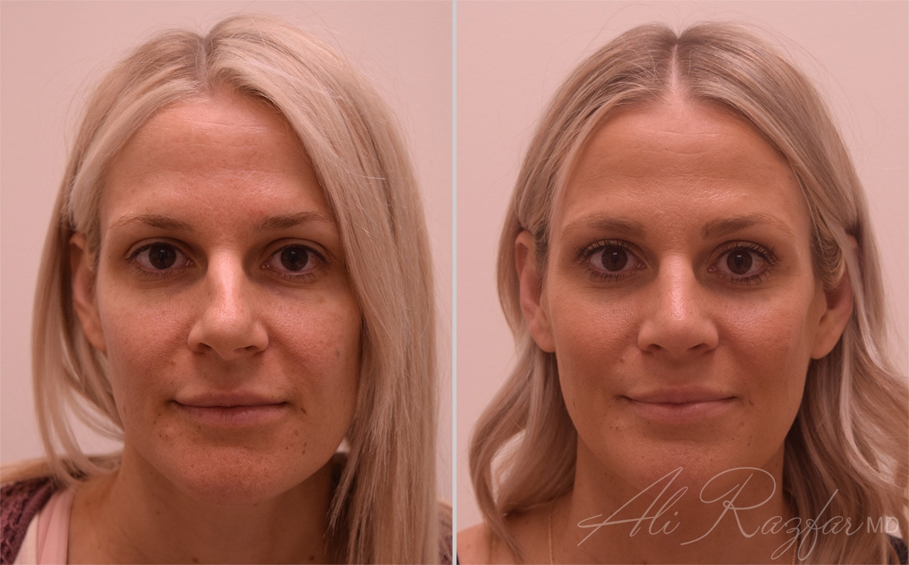 Rhinoplasty