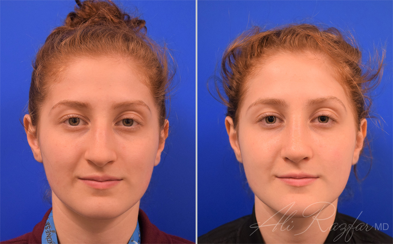 Rhinoplasty