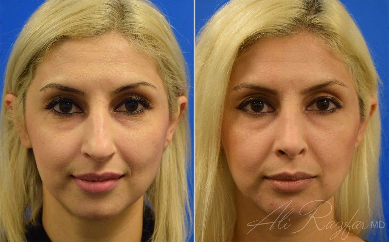 Rhinoplasty