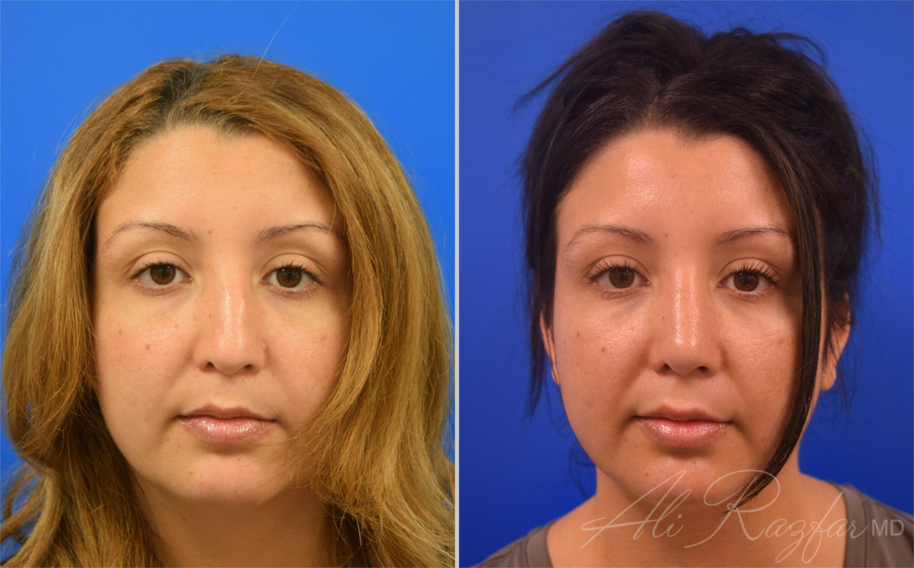 Rhinoplasty