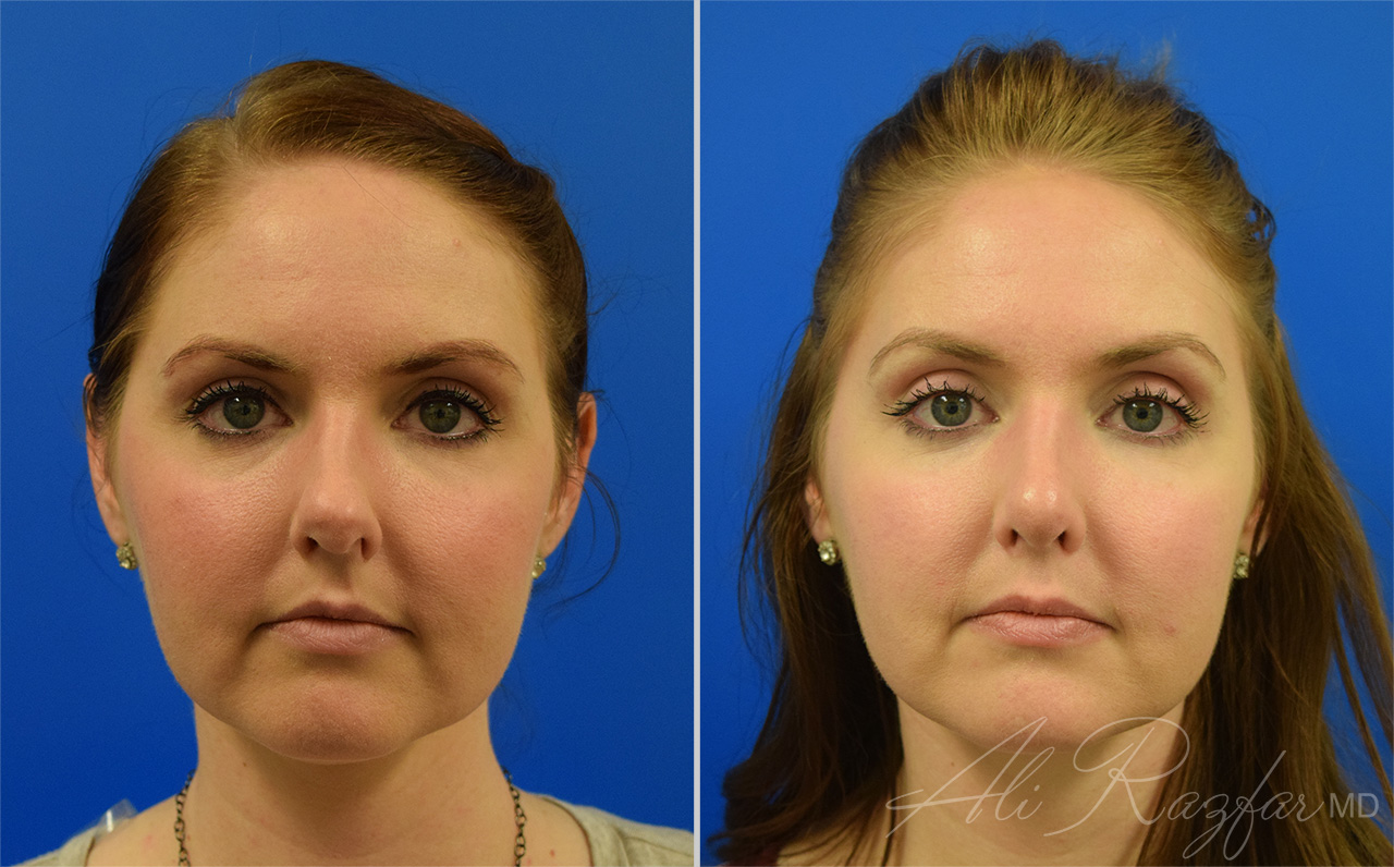 Rhinoplasty