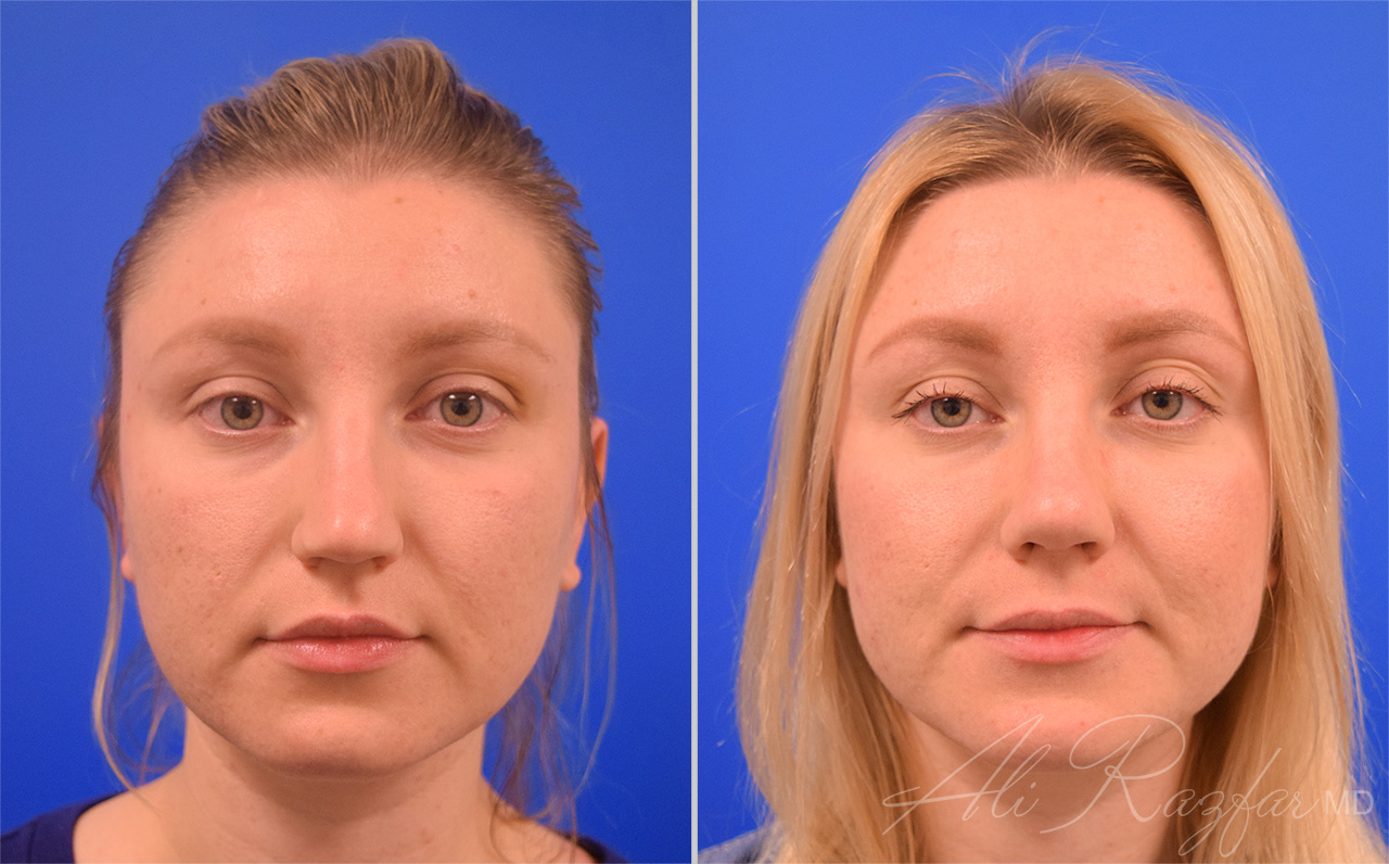 Rhinoplasty